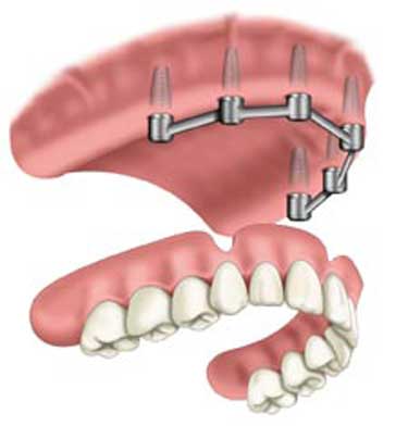 6ir-max-overdenture-stage-4-web